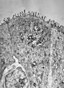 celiakia - invaded lymphocyte